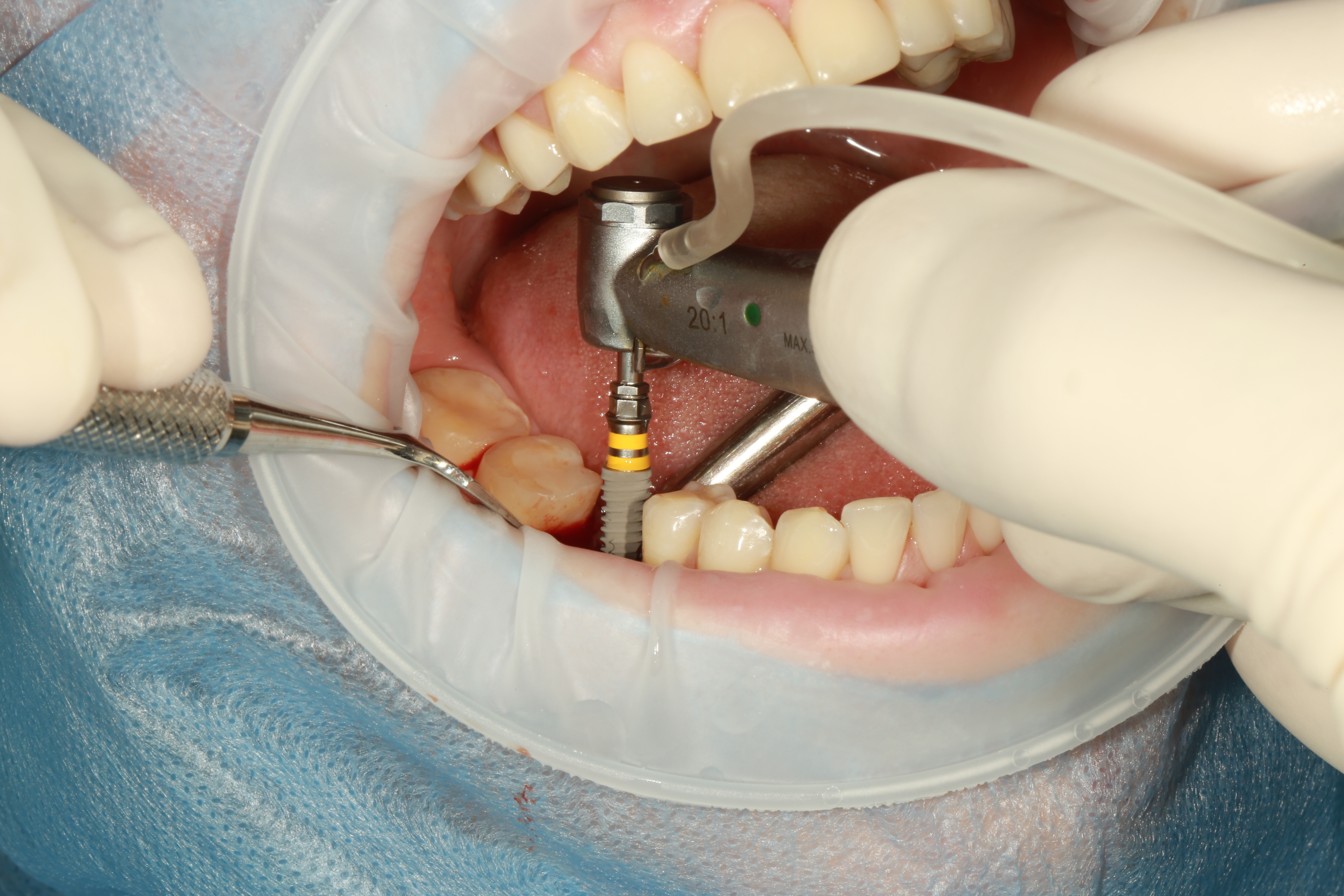 Tratamiento de implantes dentales